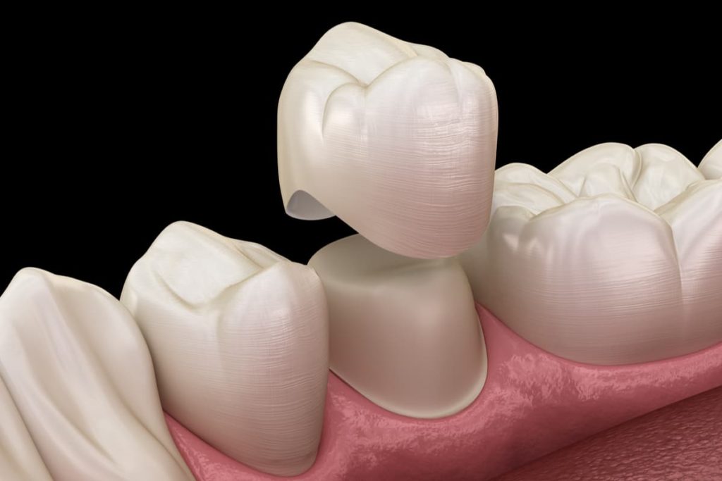 Dental Crowns & Bridges from Guttry Dental in Longview, TX