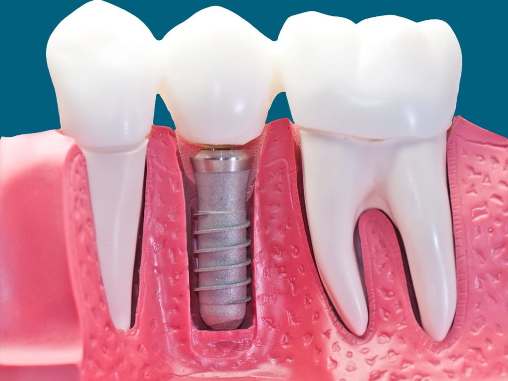 Dental Implants - Longview TX - Robert B. Guttry DDS