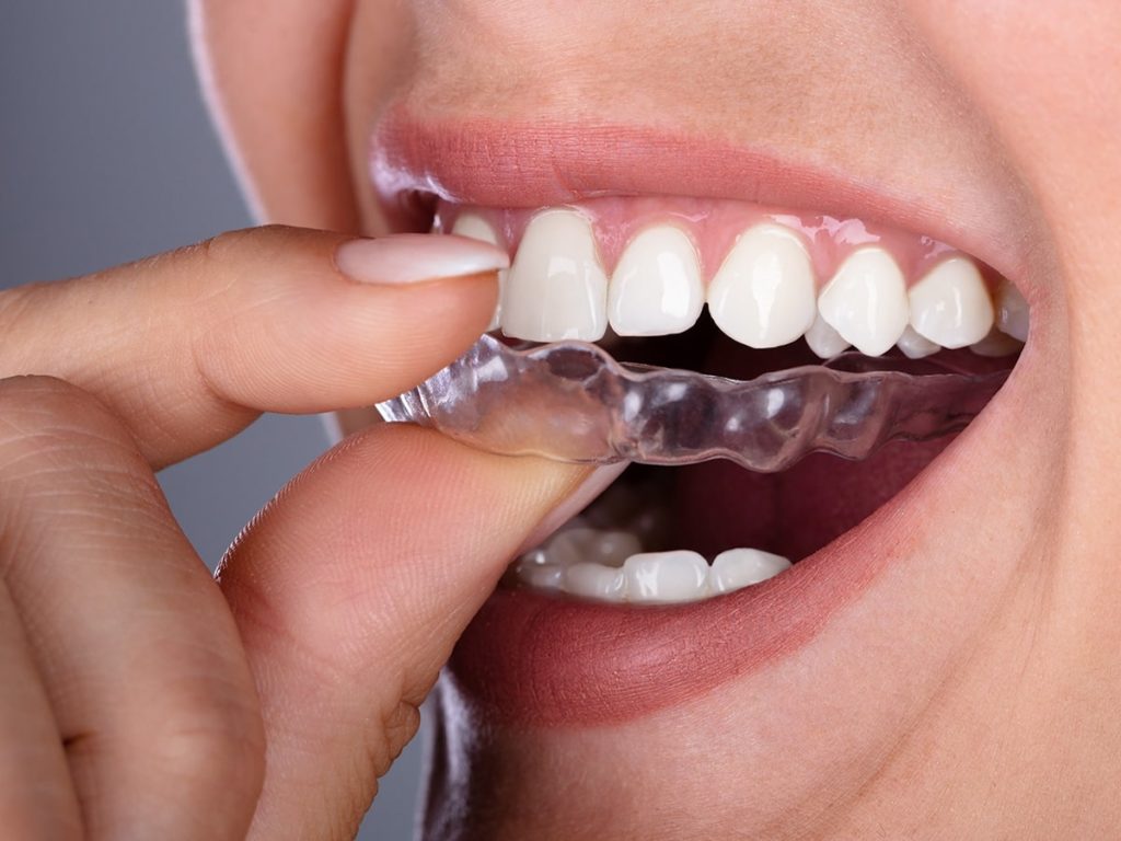 Invisalign Orthodontics - Longview TX - Robert B. Guttry DDS - Guttry Dental