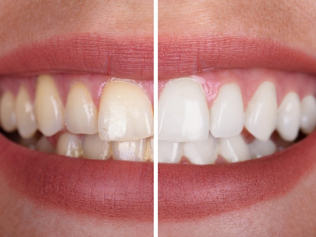 Teeth Whitening in Longview TX -Dental Bleaching - Whiter Smile - Robert B. Guttry DDS - Guttry Dental