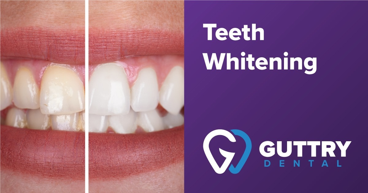 Laser teeth whitening kits