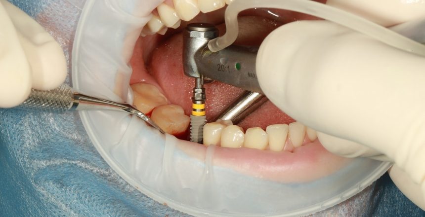 dental implant procedure